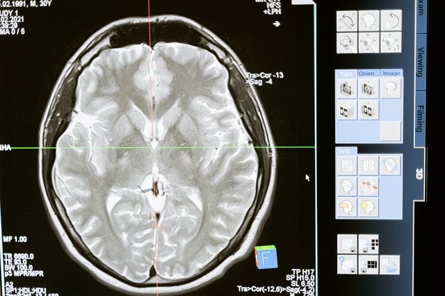 Read more about the article Zmiany w mózgu przy migrenie